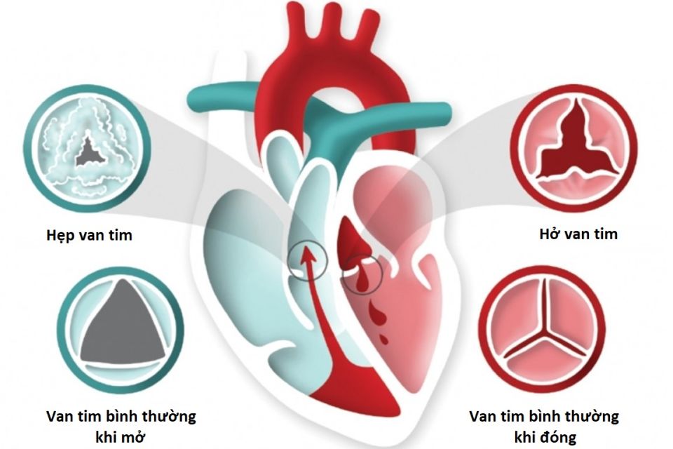 Bệnh hẹp hở van tim: Nguyên nhân, triệu chứng, cách phòng ngừa