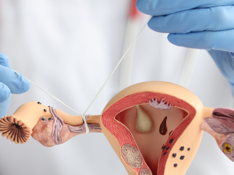 Tắc vòi trứng do viêm nhiễm hoặc ứ dịch